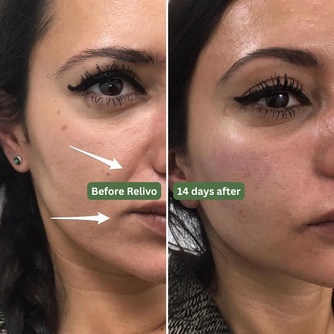 Relivo™ Facial Cupping set