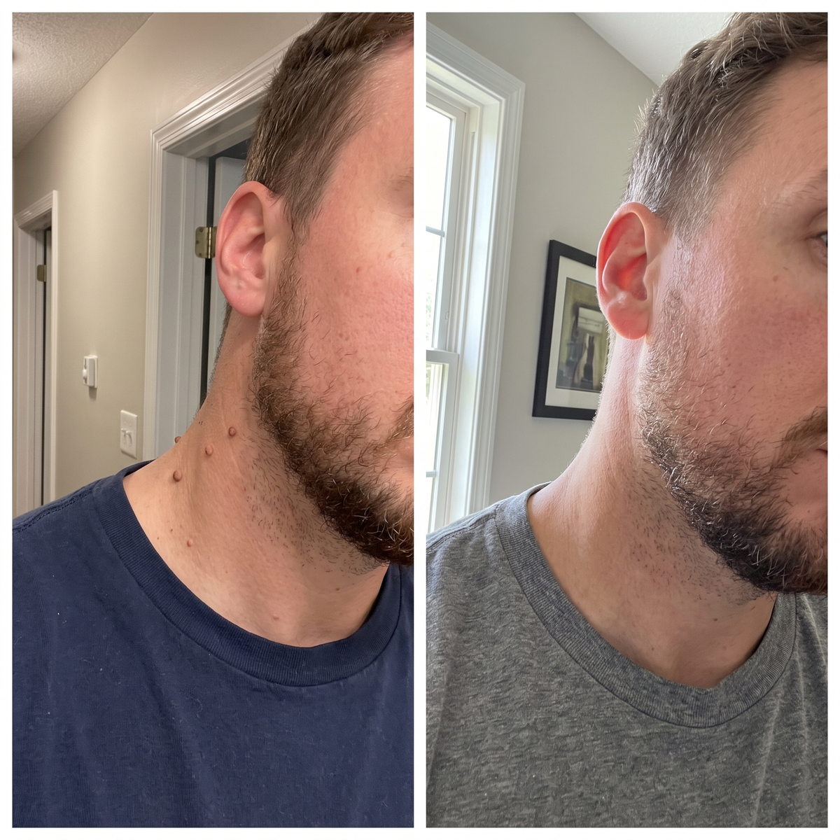 Skin tags before and after